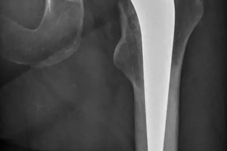 Røntgenbilde av hofteprotese